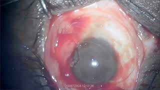 Pterygium excision with autograft By Dr K L Agrawal [upl. by Reerg]