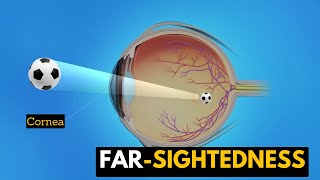 Farsightedness Causes Signs and Symptoms Diagnosis and Treatment [upl. by Bille]