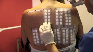 Skin Allergy Testing Using Patch Tests [upl. by Joellyn114]