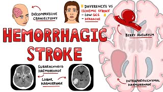 Hemorrhagic Stroke  Intracerebral Hemorrhage amp Subarachnoid Hemorrhage  Management [upl. by Latsryk]