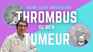 Thrombus ou Tumeur  La VEINE CAVE INFERIEURE en deux scanners démonstratifs [upl. by Stacia942]