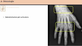 Polyarthrite rhumatoïde  CERF [upl. by Ayikan453]