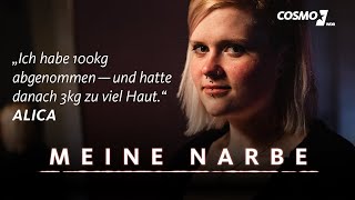 Alicas Narbe stammt von einer Bauchdeckenstraffung  Meine Narbe  COSMO [upl. by Inig]