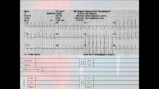 12 Lead Interpretation Part 62 EKG Changes and Lead Localization of Myocardial Infarctions [upl. by Notsirk938]