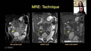 CT Versus MR Enterography PointCounterpoint [upl. by Regdor]