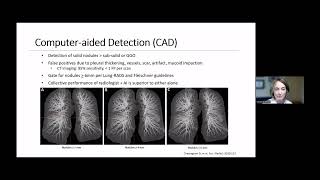 8 in 8 Series Detecting Lung Cancer Earlier Through AIPowered Software [upl. by Kazmirci]