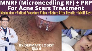 Microneedling RF MNRF Treatment For Acne Scars  MNRF Skin Treatment with PRP  Before After Results [upl. by Noteloc]