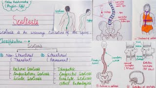 Scoliosis classification pathologydiagnosistreatment [upl. by Nagrom]