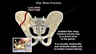 Iliac Bone Fracture  Everything You Need To Know  Dr Nabil Ebraheim [upl. by Delilah]