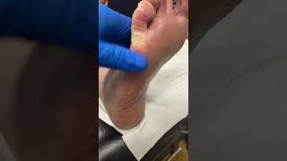 Discover the relief process Watch an Aussie Podiatrist remove painful corn amp callus [upl. by Yzzo]