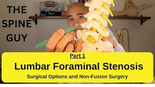 Lumbar Foraminal Stenosis  Surgical Options and NonFusion Surgery [upl. by Karilla925]