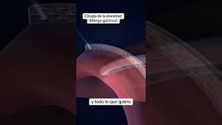 Manga gástricaplasticsurgery cirugiaplasticasegura youtubeshorts mujeres cirugiasplasticas [upl. by Duquette]