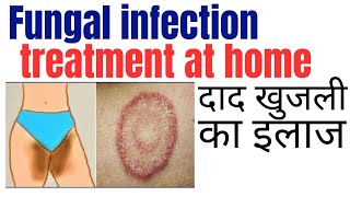 Fungal infection treatment at home  Khujli ki medicine  Daad ki best medicine [upl. by Zak]