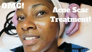 My Dermatology Acne Scar Treatment  Microneedling Experience [upl. by Pieter]