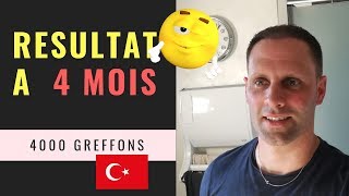 Greffe de cheveux FUE en Turquie Vidéo 12  Résultat à 4 mois  4000 Greffons [upl. by Nanete]