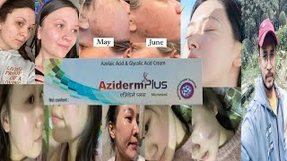 Aziderm Plus  Honest Review [upl. by Atsejam]