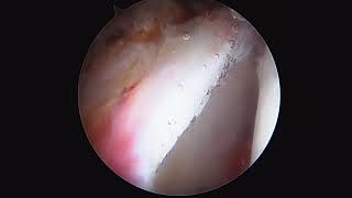 Hip Arthroscopy  Pincer resection FAI by Dr Andrew Dold MD [upl. by Cullan350]