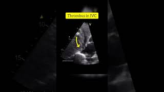 Subcostal View Showing Thrombus in IVC in a patient with Hepatocellular Carcinoma echocardiography [upl. by Otrepur]