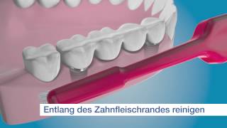 TePe ImplantatOrthodontiebürste  für die Reinigung der Außenflächen des Implantats [upl. by Web]