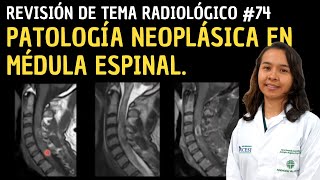 Revisión de tema 74 Patología neoplásica médula espinal [upl. by Colwin]