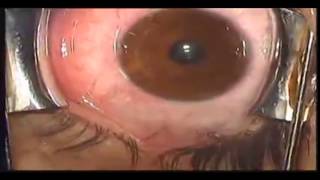 Eye Color Modification with iris implant Brightocular [upl. by Jeth]