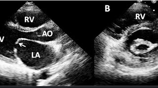 Rheumatic Heart Disease rhd echocardiography cardio heartdisease cardiovascular heartcondition [upl. by Aicetal]