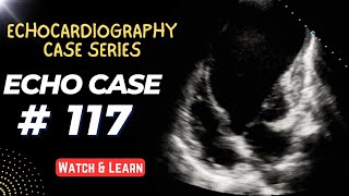 ECHO CASE 117  Echocardiography For Beginners  Echocardiogram Cases [upl. by Lilac]