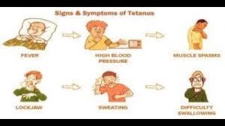 Clinical Features Signs and symptoms of Tetanus [upl. by Franklyn145]