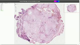 Pleomorphic Adenoma  Histopathology [upl. by Okubo]