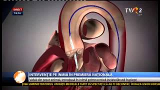 Premieră în România implantare de valvă aortică printro incizie de 5 cm în dreptul inimii [upl. by Secnarf]