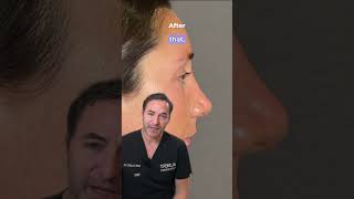 Nose Tip Rhinoplasty — Deprojecting the Tip [upl. by Lyrrad601]