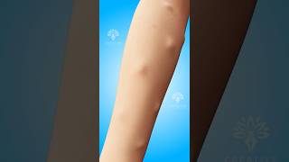 Why Do Lipomas Form Under Your Skin shorts viralvideo lipomas  Creativelearning3d [upl. by Yotal]