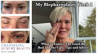 Blepharoplasty Week 1  Recovery amp What to Expect Eyelid Surgery amp CO2 Channeling Luxury Beauty [upl. by Augie]