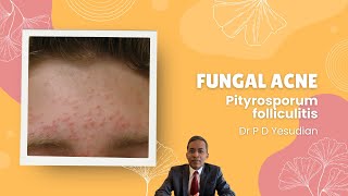 Pityrosporum or Malassezia folliculitis fungal acne [upl. by Terbecki]