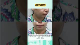 Chin Implants Instant Jawline Upgrade [upl. by Iggam]