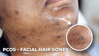 HOW TO WAX YOUR CHIN HAIR AT HOME  DIY Sugar Wax Hair Removal Hack [upl. by Winslow]