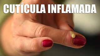 CUTÍCULA INFLAMADA  CAUSAS SINTOMAS E TRATAMENTO [upl. by Glori]