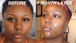 I FADED MY ACNE SCARS  GOT CLEAR SKIN DOING THIS FOR 1 MONTH VIDEO PROOF  SKINCARE ROUTINE [upl. by Burke71]