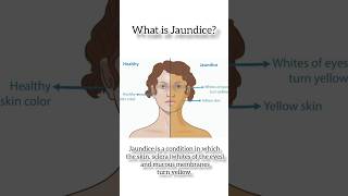 quotUnderstanding Jaundice Causes Symptoms and Treatmentquot DrAshishSachan [upl. by Guevara]