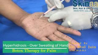 BOTOX Treatment for Sweaty Hands Palms amp Feet at Skinaa Clinic Jaipur [upl. by Else]