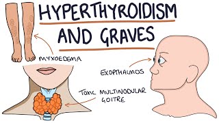 Understanding Hyperthyroidism and Graves Disease [upl. by Erlinna184]