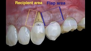 Laterally moved coronally advanced flap [upl. by Hait]