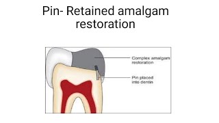 pin  retained amalgam restoration  Easy explanation [upl. by Heater]