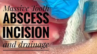 Massive dental abscess  huge popping dental abscess incision ampdrainage [upl. by Airogerg]