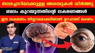 തലച്ചോറിലേക്കുള്ള ഞരമ്പുകൾ വീർത്തു ബലം കുറയുന്നതിന്റെ ലക്ഷണങ്ങൾ ഈ ലക്ഷണം നിസ്സാരമാക്കിയാൽ Dr Rinoy [upl. by Maitund986]