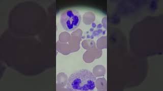 Hematology Patient with low platelets Part 1 [upl. by Cullie]