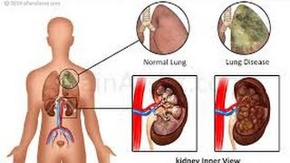 Goodpasture Syndrome [upl. by Armalda225]