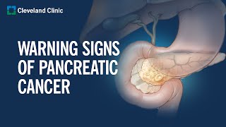 6 Warning Signs of Pancreatic Cancer [upl. by Ruthven]