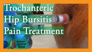 Trochanteric Hip Bursitis Pain Treatment  Auburn Medical Group [upl. by Alimat]