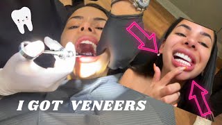 VENEERS VLOG 🦷  MY EXPERIENCE 🤕 [upl. by Negem]